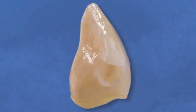 Ecusphere Shape A3 - полость III класса